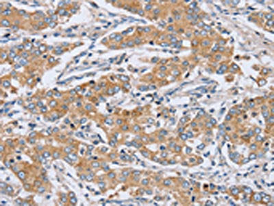 The image on the left is immunohistochemistry of paraffin-embedded Human liver cancer tissue using PTGER2 Antibody(PTGER2 Antibody) at dilution 1/20, on the right is treated with synthetic peptide. (Original magnification: ×200)Rabbit anti-Human PTGER2 Polyclonal Antibody