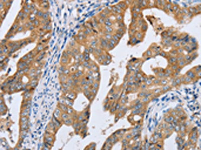 The image on the left is immunohistochemistry of paraffin-embedded Human gastic cancer tissue using the antibody Antibody) at dilution 1/20, on the right is treated with synthetic peptide. (Original magnification: ×200)Rabbit anti-Human PTGER2 Polyclonal Antibody