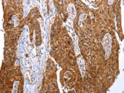 The image on the left is immunohistochemistry of paraffin-embedded Human esophagus cancer tissue using YWHAB Antibody(YWHAB Antibody) at dilution 1/10, on the right is treated with synthetic peptide. (Original magnification: ×200)Rabbit anti-Human YWHAB Polyclonal Antibody