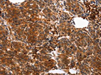 The image on the left is immunohistochemistry of paraffin-embedded Human breast cancer tissue using the antibody Antibody) at dilution 1/10, on the right is treated with synthetic peptide. (Original magnification: ×200)Rabbit anti-Human YWHAB Polyclonal Antibody