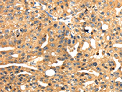 The image on the left is immunohistochemistry of paraffin-embedded Human breast cancer tissue using SH3KBP1 Antibody(SH3KBP1 Antibody) at dilution 1/45, on the right is treated with fusion protein. (Original magnification: ×200)Rabbit anti-Human SH3KBP1 Polyclonal Antibody