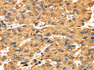 The image on the left is immunohistochemistry of paraffin-embedded Human liver cancer tissue using the antibody Antibody) at dilution 1/45, on the right is treated with fusion protein. (Original magnification: ×200)Rabbit anti-Human SH3KBP1 Polyclonal Antibody