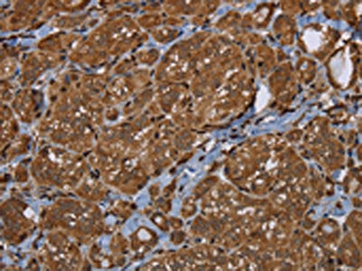 The image on the left is immunohistochemistry of paraffin-embedded Human thyroid cancer tissue using HSD17B4 Antibody(HSD17B4 Antibody) at dilution 1/30, on the right is treated with fusion protein. (Original magnification: ×200)Rabbit anti-Human HSD17B4 Polyclonal Antibody