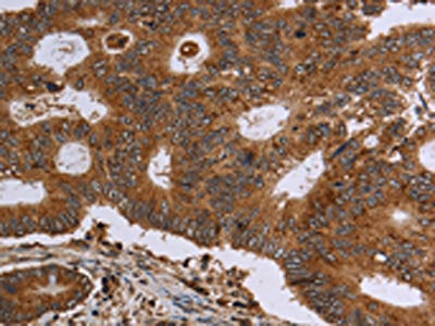 The image on the left is immunohistochemistry of paraffin-embedded Human colon cancer tissue using the antibody Antibody) at dilution 1/30, on the right is treated with fusion protein. (Original magnification: ×200)Rabbit anti-Human HSD17B4 Polyclonal Antibody