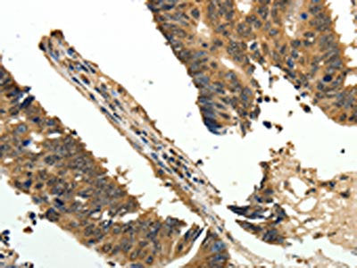 The image on the left is immunohistochemistry of paraffin-embedded Human colon cancer tissue using ODC1 Antibody(ODC1 Antibody) at dilution 1/30, on the right is treated with fusion protein. (Original magnification: ×200)Rabbit anti-Human ODC1 Polyclonal Antibody