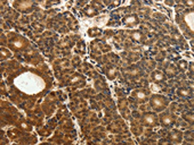 The image on the left is immunohistochemistry of paraffin-embedded Human thyroid cancer tissue using the antibody Antibody) at dilution 1/30, on the right is treated with fusion protein. (Original magnification: ×200)Rabbit anti-Human ODC1 Polyclonal Antibody