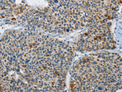 The image on the left is immunohistochemistry of paraffin-embedded Human liver cancer tissue using the antibody Antibody) at dilution 1/30, on the right is treated with synthetic peptide. (Original magnification: ×200)