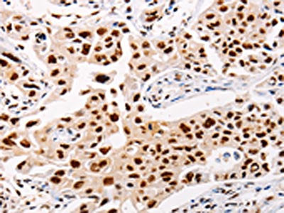 The image on the left is immunohistochemistry of paraffin-embedded Human lung cancer tissue using AKAP8L Antibody(AKAP8L Antibody) at dilution 1/20, on the right is treated with fusion protein. (Original magnification: ×200)Rabbit anti-Human AKAP8L Polyclonal Antibody