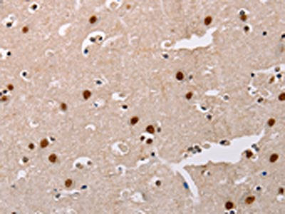 The image on the left is immunohistochemistry of paraffin-embedded Human brain tissue using the antibody Antibody) at dilution 1/20, on the right is treated with fusion protein. (Original magnification: ×200)Rabbit anti-Human AKAP8L Polyclonal Antibody