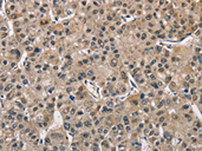 The image on the left is immunohistochemistry of paraffin-embedded Human liver cancer tissue using the antibody Antibody) at dilution 1/40, on the right is treated with fusion protein. (Original magnification: X200)Rabbit anti-Human PGK1 Polyclonal Antibody