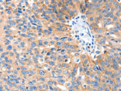 The image on the left is immunohistochemistry of paraffin-embedded Human ovarian cancer tissue using SLC2A1 Antibody(SLC2A1 Antibody) at dilution 1/40, on the right is treated with synthetic peptide. (Original magnification: ×200)Rabbit anti-Human SLC2A1 Polyclonal Antibody
