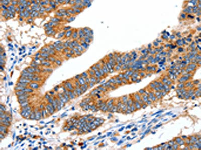 The image on the left is immunohistochemistry of paraffin-embedded Human colon cancer tissue using the antibody Antibody) at dilution 1/40, on the right is treated with synthetic peptide. (Original magnification: ×200)Rabbit anti-Human SLC2A1 Polyclonal Antibody