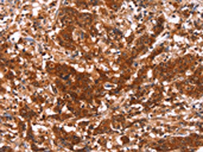 The image on the left is immunohistochemistry of paraffin-embedded Human gastric cancer tissue using HAS1 Antibody(HAS1 Antibody) at dilution 1/30, on the right is treated with synthetic peptide. (Original magnification: ×200)Rabbit anti-Human HAS1 Polyclonal Antibody