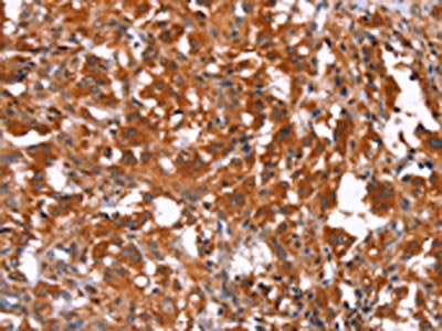The image on the left is immunohistochemistry of paraffin-embedded Human thyroid cancer tissue using the antibody Antibody) at dilution 1/30, on the right is treated with synthetic peptide. (Original magnification: ×200)Rabbit anti-Human HAS1 Polyclonal Antibody