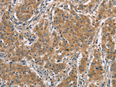 The image on the left is immunohistochemistry of paraffin-embedded Human gastric cancer tissue using DCTN1 Antibody(DCTN1 Antibody) at dilution 1/50, on the right is treated with fusion protein. (Original magnification: ×200)Rabbit anti-Human DCTN1 Polyclonal Antibody