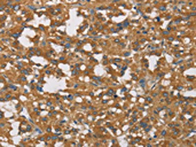 The image on the left is immunohistochemistry of paraffin-embedded Human thyroid cancer tissue using the antibody Antibody) at dilution 1/50, on the right is treated with fusion protein. (Original magnification: ×200)Rabbit anti-Human DCTN1 Polyclonal Antibody
