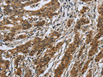The image on the left is immunohistochemistry of paraffin-embedded Human gastric cancer tissue using IL5RA Antibody(IL5RA Antibody) at dilution 1/40, on the right is treated with synthetic peptide. (Original magnification: ×200)Rabbit anti-Human IL5RA Polyclonal Antibody