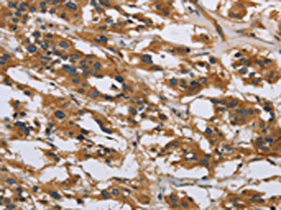 The image on the left is immunohistochemistry of paraffin-embedded Human thyroid cancer tissue using the antibody Antibody) at dilution 1/40, on the right is treated with synthetic peptide. (Original magnification: ×200)Rabbit anti-Human IL5RA Polyclonal Antibody