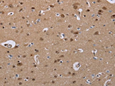 The image on the left is immunohistochemistry of paraffin-embedded Human brain  tissue using CDK5 Antibody(CDK5 Antibody) at dilution 1/30, on the right is treated with fusion protein. (Original magnification: ×200)Rabbit anti-Human CDK5 Polyclonal Antibody