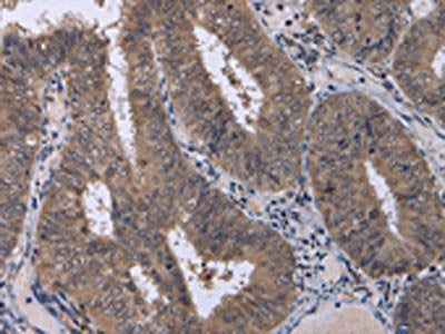 The image on the left is immunohistochemistry of paraffin-embedded Human colon cancer tissue using the antibody Antibody) at dilution 1/30, on the right is treated with fusion protein. (Original magnification: ×200)Rabbit anti-Human CDK5 Polyclonal Antibody