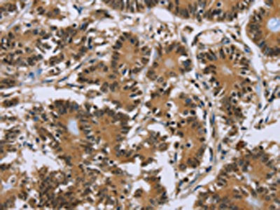 The image on the left is immunohistochemistry of paraffin-embedded Human colon cancer tissue using P2RY1 Antibody(P2RY1 Antibody) at dilution 1/40, on the right is treated with synthetic peptide. (Original magnification: ×200)Rabbit anti-Human P2RY1 Polyclonal Antibody
