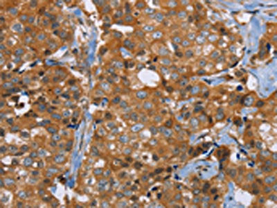 The image on the left is immunohistochemistry of paraffin-embedded Human breast cancer tissue using the antibody Antibody) at dilution 1/40, on the right is treated with synthetic peptide. (Original magnification: ×200)Rabbit anti-Human P2RY1 Polyclonal Antibody