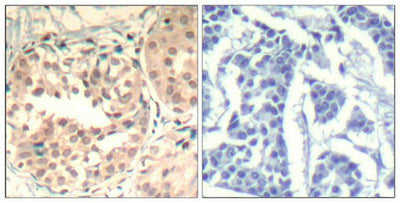 Immunohistochemical analysis of paraffin-embedded human breast carcinoma tissue using CDK6(Phospho-Tyr13) Antibody(left) or the same antibody preincubated with blocking peptide(right).Rabbit anti-Human CDK6 Polyclonal Antibody