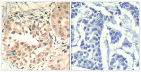 Immunohistochemical analysis of paraffin-embedded human breast carcinoma tissue using CDK6(Phospho-Tyr13) Antibody(left) or the same antibody preincubated with blocking peptide(right).Rabbit anti-Human CDK6 Polyclonal Antibody