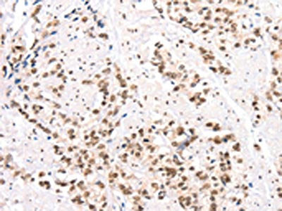 The image on the left is immunohistochemistry of paraffin-embedded Human prostate cancer tissue using CTBP2 Antibody(CTBP2 Antibody) at dilution 1/40, on the right is treated with synthetic peptide. (Original magnification: ×200)Rabbit anti-Human CTBP2 Polyclonal Antibody