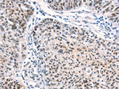 The image on the left is immunohistochemistry of paraffin-embedded Human ovarian cancer tissue using the antibody Antibody) at dilution 1/40, on the right is treated with synthetic peptide. (Original magnification: ×200)Rabbit anti-Human CTBP2 Polyclonal Antibody