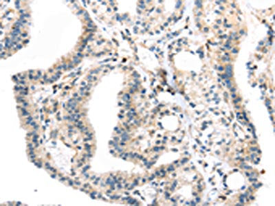 The image on the left is immunohistochemistry of paraffin-embedded Human thyroid cancer tissue using TBXA2R Antibody(TBXA2R Antibody) at dilution 1/40, on the right is treated with synthetic peptide. (Original magnification: ×200)Rabbit anti-Human TBXA2R Polyclonal Antibody