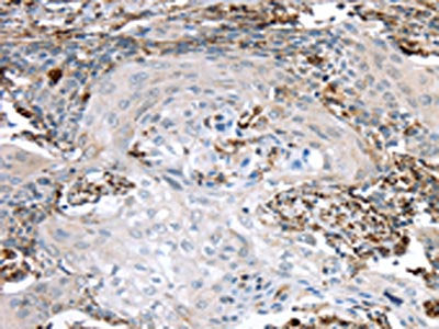 The image on the left is immunohistochemistry of paraffin-embedded Human cervical cancer tissue using the antibody Antibody) at dilution 1/40, on the right is treated with synthetic peptide. (Original magnification: ×200)Rabbit anti-Human TBXA2R Polyclonal Antibody