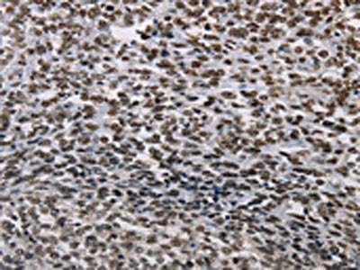 The image on the left is immunohistochemistry of paraffin-embedded Human ovarian cancer tissue using AKAP8L Antibody(AKAP8L Antibody) at dilution 1/15, on the right is treated with fusion protein. (Original magnification: ×200)Rabbit anti-Human AKAP8L Polyclonal Antibody