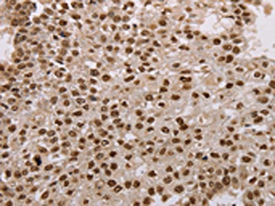The image on the left is immunohistochemistry of paraffin-embedded Human breast cancer tissue using the antibody Antibody) at dilution 1/15, on the right is treated with fusion protein. (Original magnification: ×200)Rabbit anti-Human AKAP8L Polyclonal Antibody