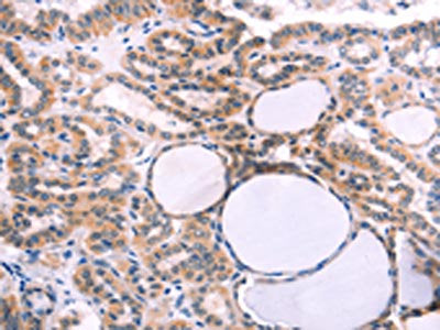 The image on the left is immunohistochemistry of paraffin-embedded Human thyroid cancer tissue using IL1RL1 Antibody(IL1RL1 Antibody) at dilution 1/40, on the right is treated with fusion protein. (Original magnification: ×200)Rabbit anti-Human IL1RL1 Polyclonal Antibody