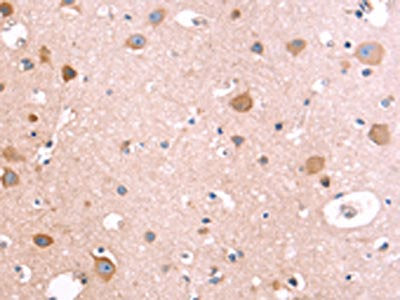 The image on the left is immunohistochemistry of paraffin-embedded Human brain tissue using the antibody Antibody) at dilution 1/40, on the right is treated with fusion protein. (Original magnification: ×200)