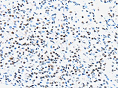 The image on the left is immunohistochemistry of paraffin-embedded Human prostate cancer tissue using UBA1 Antibody(UBA1 Antibody) at dilution 1/40, on the right is treated with synthetic peptide. (Original magnification: ×200)Rabbit anti-Human UBA1 Polyclonal Antibody