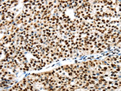 The image on the left is immunohistochemistry of paraffin-embedded Human breast cancer tissue using the antibody Antibody) at dilution 1/40, on the right is treated with synthetic peptide. (Original magnification: ×200)Rabbit anti-Human UBA1 Polyclonal Antibody