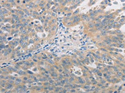 The image on the left is immunohistochemistry of paraffin-embedded Human ovarian cancer tissue using GJB6 Antibody(GJB6 Antibody) at dilution 1/60, on the right is treated with synthetic peptide. (Original magnification: ×200)Rabbit anti-Human GJB6 Polyclonal Antibody
