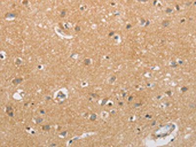 The image on the left is immunohistochemistry of paraffin-embedded Human brain tissue using the antibody Antibody) at dilution 1/60, on the right is treated with synthetic peptide. (Original magnification: ×200)Rabbit anti-Human GJB6 Polyclonal Antibody