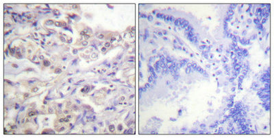 Immunohistochemical analysis of paraffin-embedded human lung carcinoma tissue using hnRPD (Phospho-Ser83) antibody (left)or the same antibody preincubated with blocking peptide (right).Rabbit anti-Human HNRNPD Polyclonal Antibody