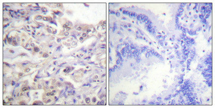 Immunohistochemical analysis of paraffin-embedded human lung carcinoma tissue using hnRPD (Phospho-Ser83) antibody (left)or the same antibody preincubated with blocking peptide (right).Rabbit anti-Human HNRNPD Polyclonal Antibody