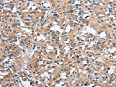 The image on the left is immunohistochemistry of paraffin-embedded Human thyroid cancer tissue using PAK2 Antibody(PAK2 Antibody) at dilution 1/40, on the right is treated with fusion protein. (Original magnification: ×200)Rabbit anti-Human PAK2 Polyclonal Antibody