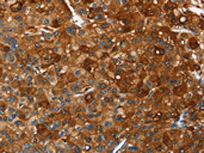 The image on the left is immunohistochemistry of paraffin-embedded Human liver cancer tissue using the antibody Antibody) at dilution 1/40, on the right is treated with fusion protein. (Original magnification: ×200)Rabbit anti-Human PAK2 Polyclonal Antibody
