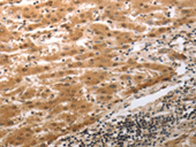 The image on the left is immunohistochemistry of paraffin-embedded Human liver cancer tissue using MMP27 Antibody(MMP27 Antibody) at dilution 1/40, on the right is treated with synthetic peptide. (Original magnification: ×200)Rabbit anti-Human MMP27 Polyclonal Antibody
