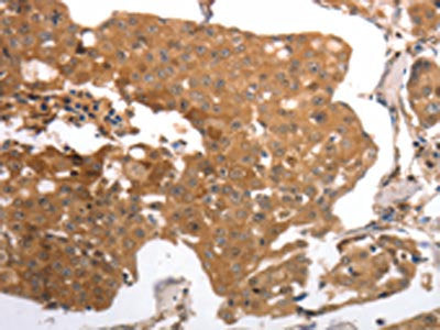 The image on the left is immunohistochemistry of paraffin-embedded Human breast cancer tissue using the antibody Antibody) at dilution 1/40, on the right is treated with synthetic peptide. (Original magnification: ×200)