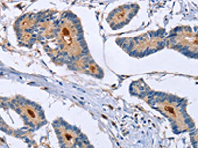The image on the left is immunohistochemistry of paraffin-embedded Human colon cancer tissue using GMFG Antibody(GMFG Antibody) at dilution 1/50, on the right is treated with fusion protein. (Original magnification: ×200)Rabbit anti-Human GMFG Polyclonal Antibody