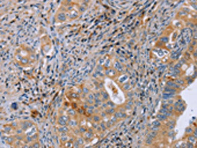 The image on the left is immunohistochemistry of paraffin-embedded Human cervical cancer tissue using the antibody Antibody) at dilution 1/50, on the right is treated with fusion protein. (Original magnification: ×200)Rabbit anti-Human GMFG Polyclonal Antibody