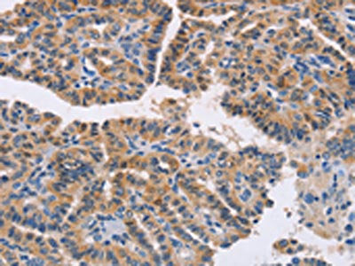 The image on the left is immunohistochemistry of paraffin-embedded Human thyroid cancer tissue using NCR1 Antibody(NCR1 Antibody) at dilution 1/20, on the right is treated with synthetic peptide. (Original magnification: ×200)Rabbit anti-Human NCR1 Polyclonal Antibody