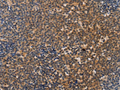 The image on the left is immunohistochemistry of paraffin-embedded Human Lymphoma tissue using the antibody Antibody) at dilution 1/20, on the right is treated with synthetic peptide. (Original magnification: ×200)Rabbit anti-Human NCR1 Polyclonal Antibody